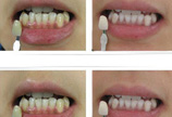 牙周病对比图