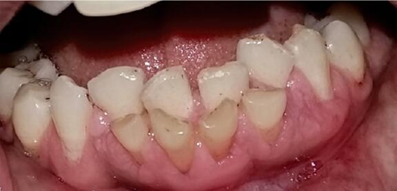 孩子出现双排牙,是否和食物太精细有关?