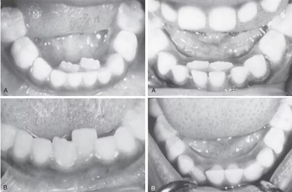 孩子出现双排牙,是否和食物太精细有关?