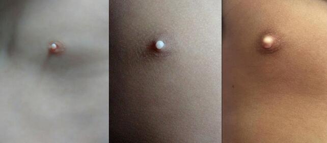 宝宝乳头上的白点是什么?怎么处理?