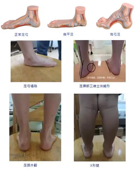 扁平足怎么判断 扁平足的危害