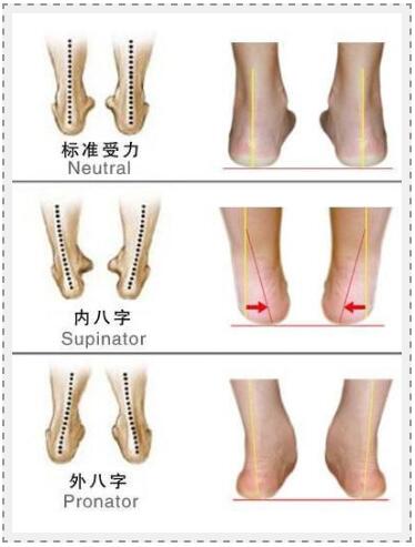 扁平足怎么判断 扁平足的危害