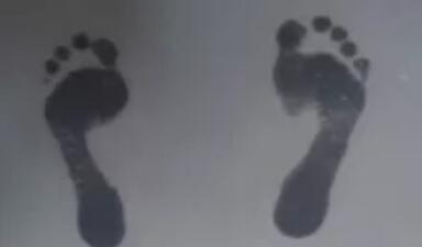 扁平足怎么判断 扁平足的危害