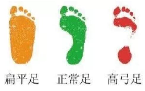 扁平足怎么判断 扁平足的危害
