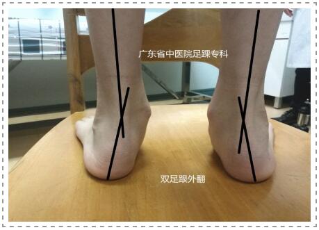 扁平足怎么判断 扁平足的危害