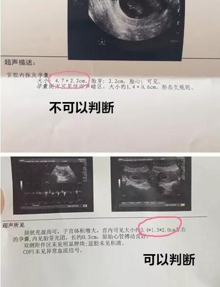 孕囊形状看性别准不准