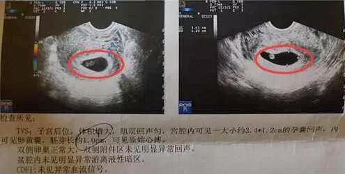 10秒测出怀男孩和女孩，几个方法屡试不爽