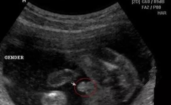 四维彩超怎么看男女怎么看