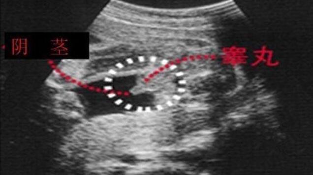 四维彩超怎么看男女怎么看