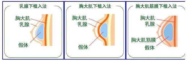 隆胸可以喂奶吗