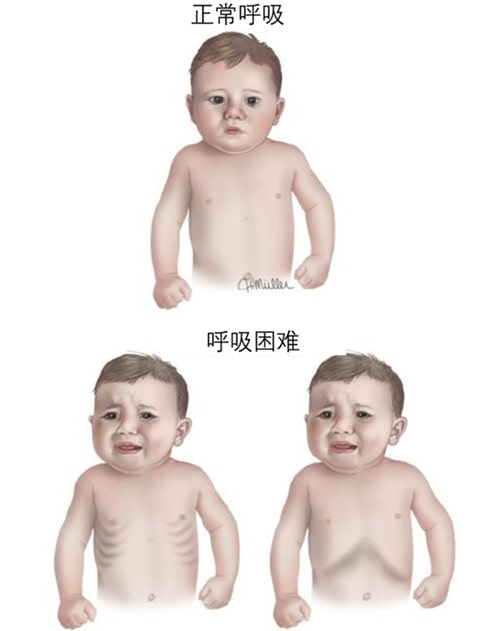 怎么判断是不是得了小儿肺炎?