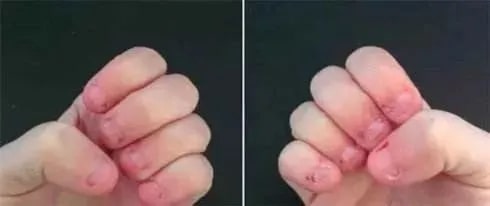 婴儿吃手要不要强行制止?