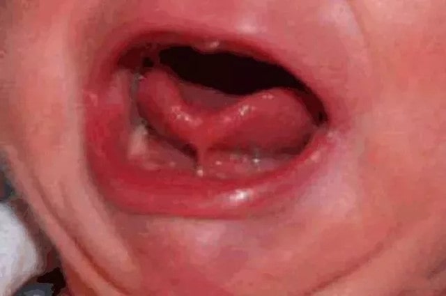 宝宝舌系带过短,一定要手术吗?