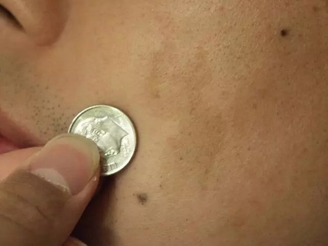 宝宝身上淤青,蒙古斑是怎么回事?