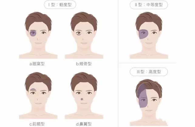 宝宝身上淤青,蒙古斑是怎么回事?