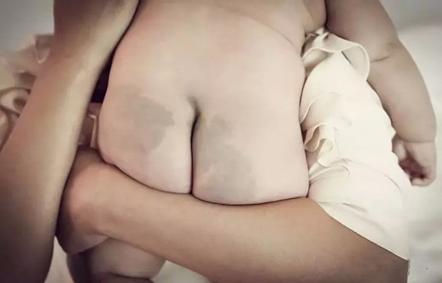 宝宝身上淤青,蒙古斑是怎么回事?