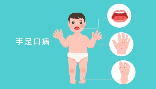 四岁宝宝手足口病一直发烧正常吗?