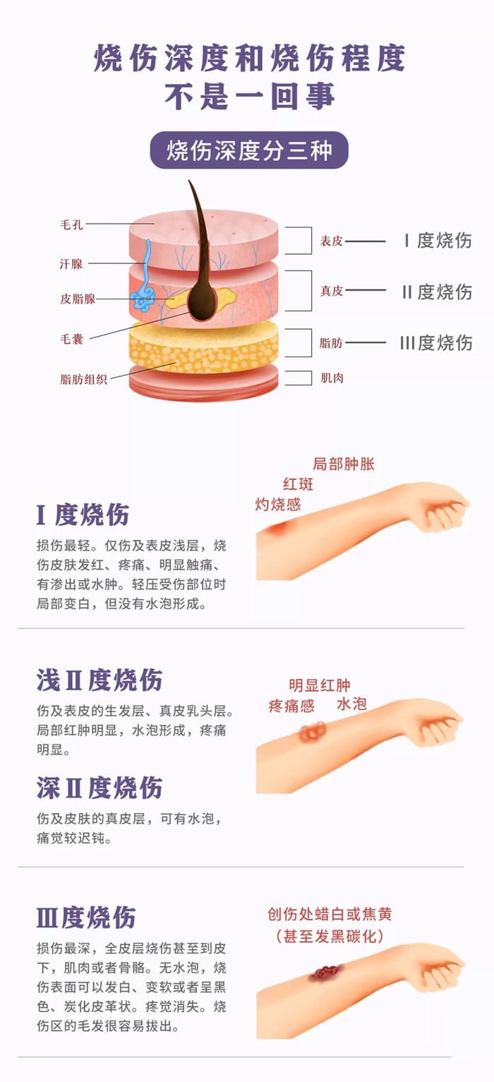 宝宝不小心烫伤了怎么办？记住这五字诀
