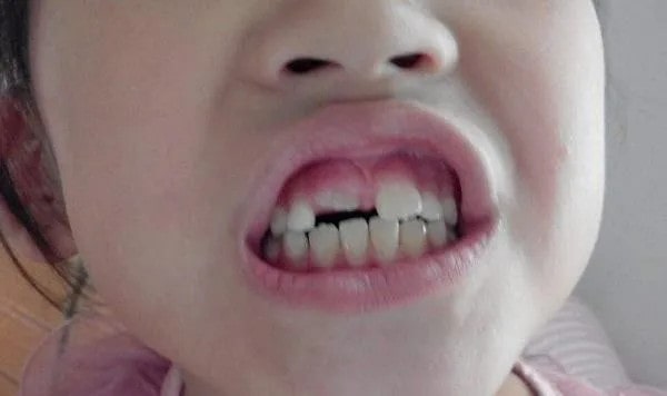 儿童换牙注意事项，需注意这5个方面