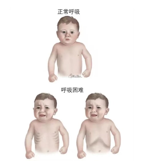 怎么判断宝宝是不是得了肺炎?